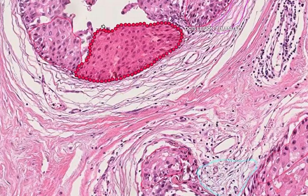 ai cancer detection