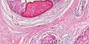 ai cancer detection