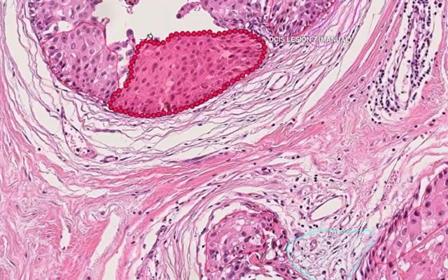 ai cancer detection