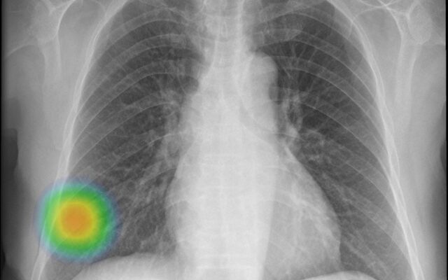 ai lung abnormality detection
