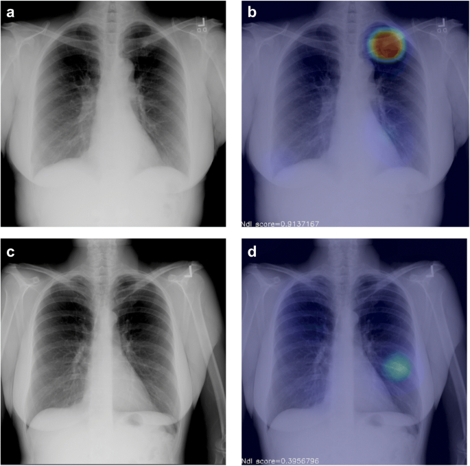 ai lung abnormality detection